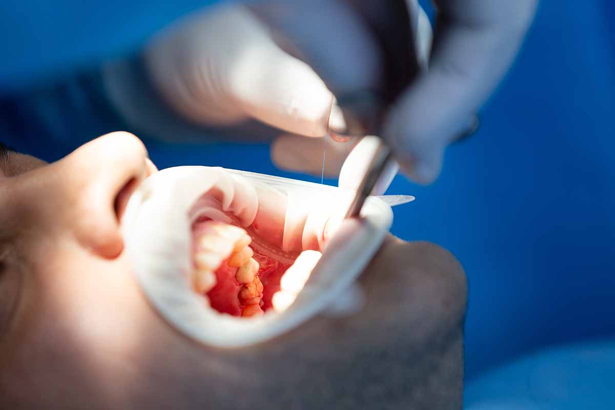 Eyüpsultan Kanal Tedavisi Tekrarı - Lisan Klinik